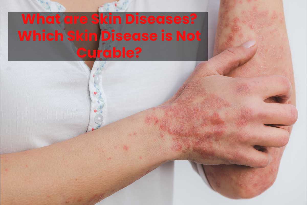 What Are Skin Diseases Which Skin Disease Is Not Curable 